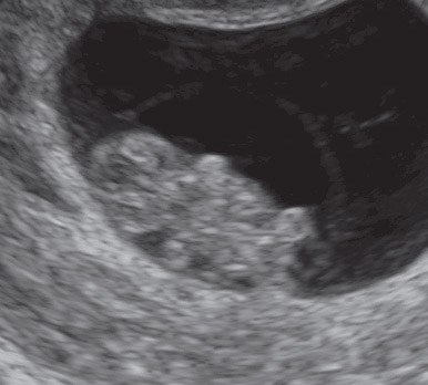 Ultraschall in der 8. SSW