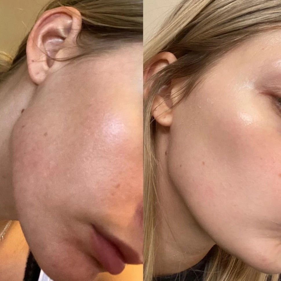 Vorher-Nachher-Effekt durch Azelainsäure-Serum Vorher-Nachher-Effekt durch Azelainsäure-Serum