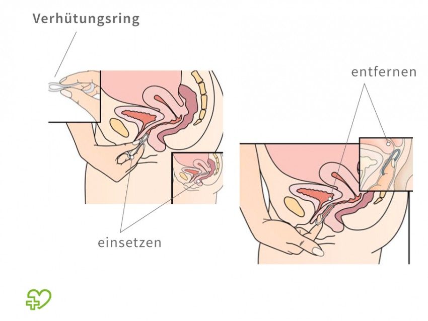 So sitzt der Verh&uuml;tungsring richtig