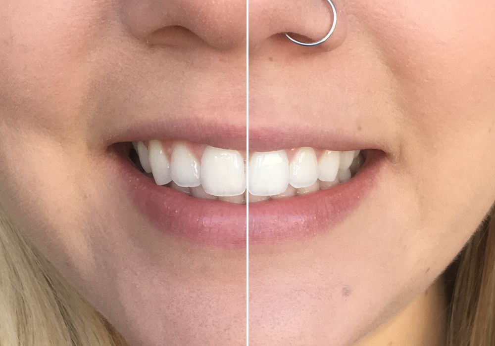 Zahnbleaching-Test Zahnbleaching-Test