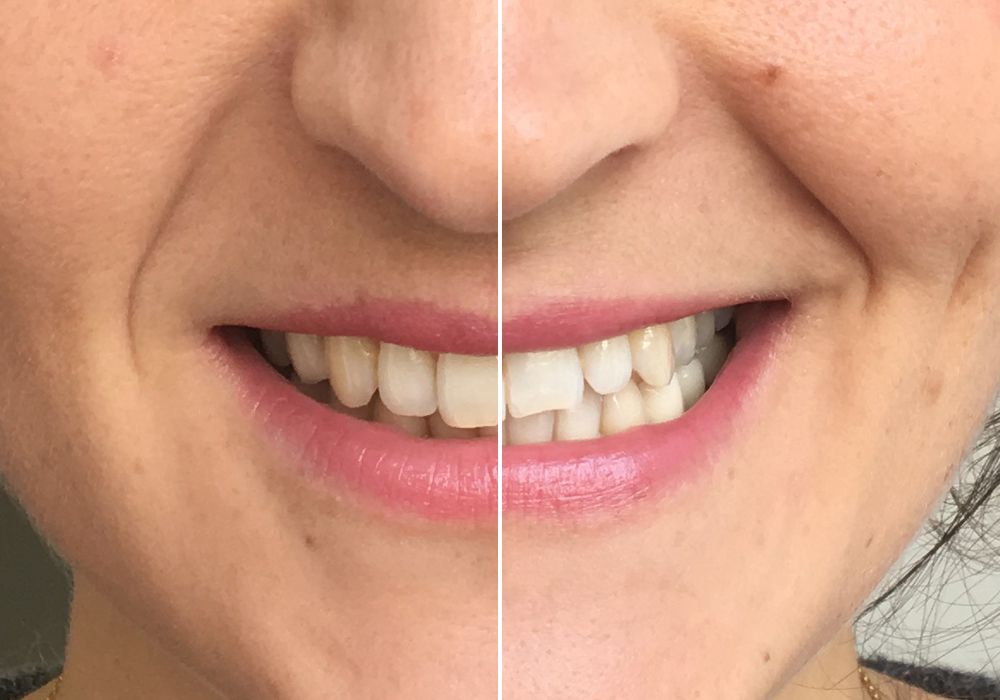 Zahnbleaching-Test Zahnbleaching-Test