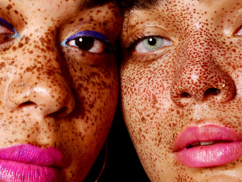 Junge Frauen mit vielen kleinen P&uuml;nktchen im Gesicht.
