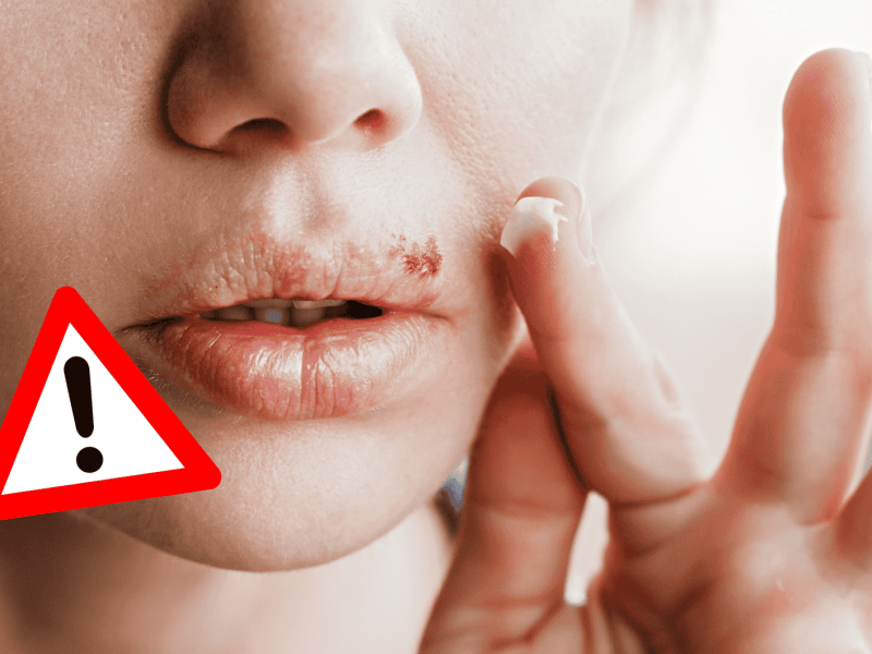 Frau hat Lippenherpes und gibt Creme darauf.